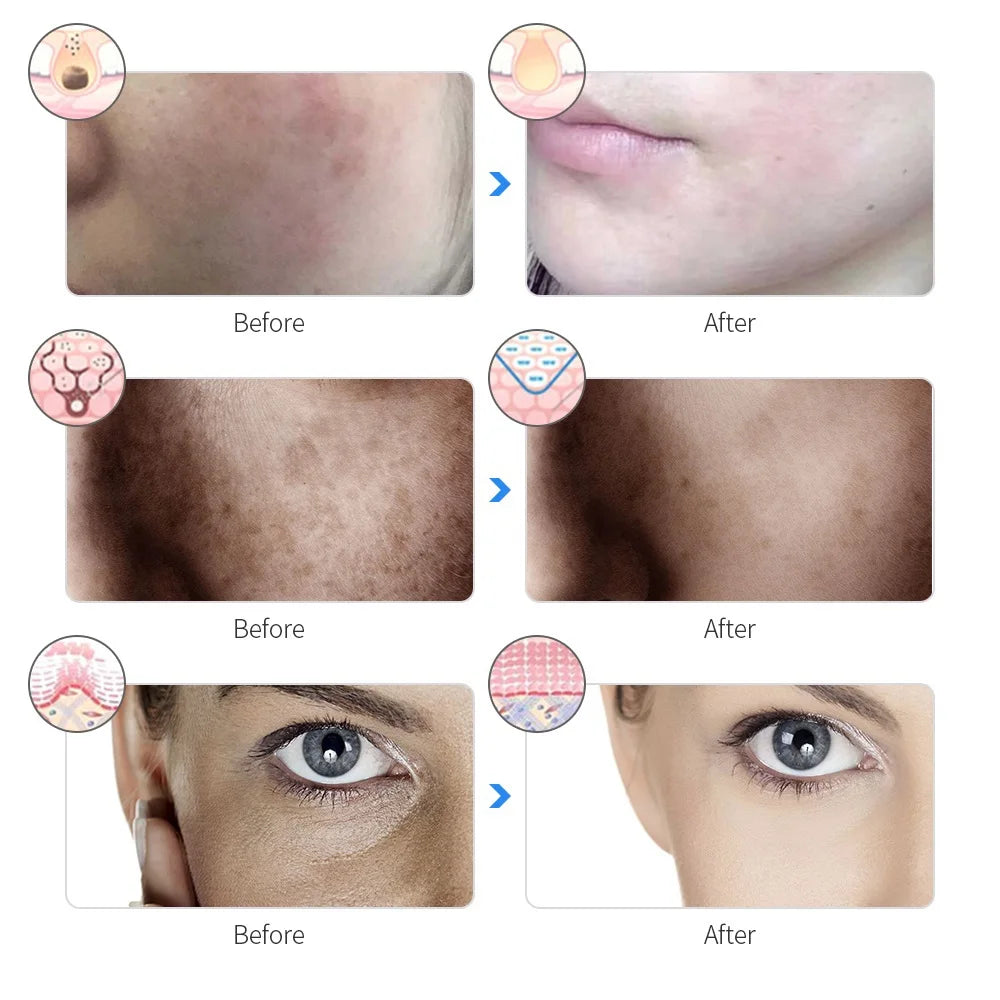 GlowEase Pro™ LED Therapy Mask